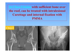 In Class-I lesion with sufficient bone over
the roof, can be treated with intralesional
Curettage and internal fixation withCurettage and internal fixation with
PMMA
Class-I
1/14/2011 46Professor Freih AbuHassan -UJ
 