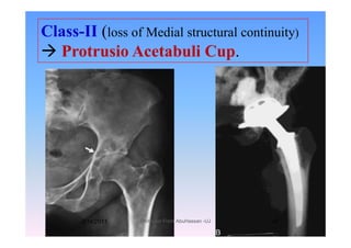 Class-II (loss of Medial structural continuity)(
Protrusio Acetabuli Cup.
1/14/2011 47Professor Freih AbuHassan -UJ
 