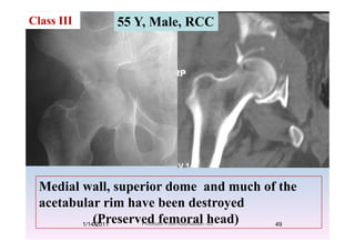 Class III 55 Y, Male, RCC
M di l ll i d d h f thMedial wall, superior dome and much of the
acetabular rim have been destroyed
(Preserved femoral head)1/14/2011 49Professor Freih AbuHassan -UJ
 