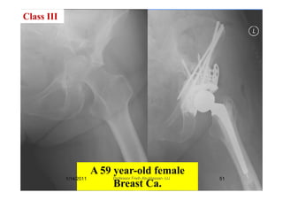 Class III
A 59 ld f lA 59 year-old female
Breast Ca.
1/14/2011 51Professor Freih AbuHassan -UJ
 