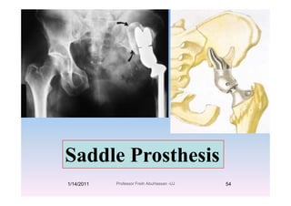 S ddl P th iSaddle Prosthesis
1/14/2011 54Professor Freih AbuHassan -UJ
 
