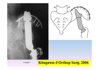 Kitagawa. J Orthop Surg. 20061/14/2011 55Professor Freih AbuHassan -UJ
 