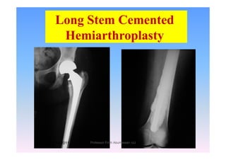 Long Stem Cementedg
Hemiarthroplasty
1/14/2011 59Professor Freih AbuHassan -UJ
 