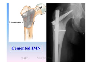 C t d IMNCemented IMN
1/14/2011 61Professor Freih AbuHassan -UJ
 