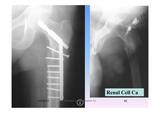Renal Cell Ca
1/14/2011 65Professor Freih AbuHassan -UJ
 