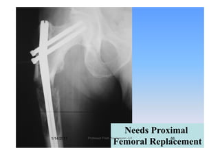 Needs ProximalNeeds Proximal
Femoral Replacement
1/14/2011 66Professor Freih AbuHassan -UJ
 