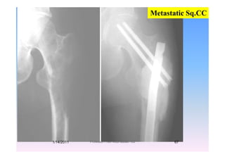 Metastatic Sq.CC
1/14/2011 67Professor Freih AbuHassan -UJ
 