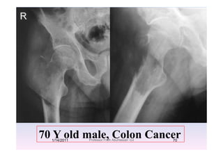 70 Y ld l C l C70 Y old male, Colon Cancer1/14/2011 70Professor Freih AbuHassan -UJ
 