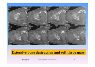 Extensive bone destruction and soft tissue mass
1/14/2011 71Professor Freih AbuHassan -UJ
 