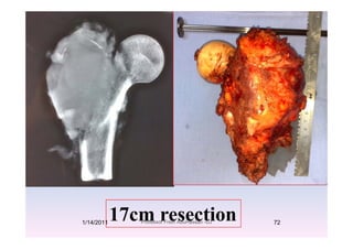 17 ti17cm resection1/14/2011 72Professor Freih AbuHassan -UJ
 