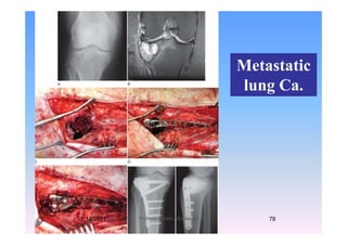 MetastaticMetastatic
lung Ca.
1/14/2011 78Professor Freih AbuHassan -UJ
 
