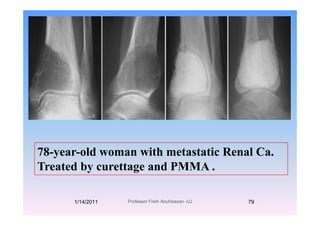 78-year-old woman with metastatic Renal Ca.
T t d b tt d PMMATreated by curettage and PMMA .
1/14/2011 79Professor Freih AbuHassan -UJ
 