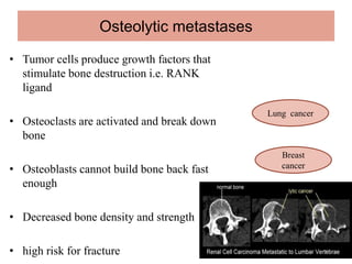 Bone Mets Types Bone metastasis | PPT