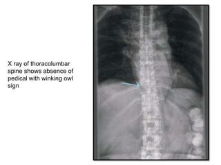 Bone metastasis | PPT