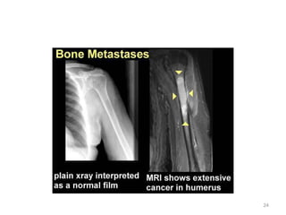 Bone Mets Types Bone metastasis | PPT