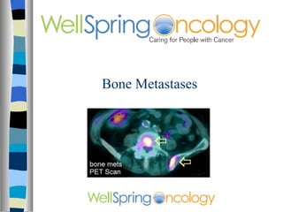 Bone Metastases 