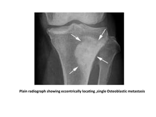Plain radiograph showing eccentrically locating ,single Osteoblastic metastasis
 