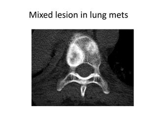Mixed lesion in lung mets
 