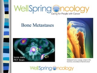 Bone Metastases
 