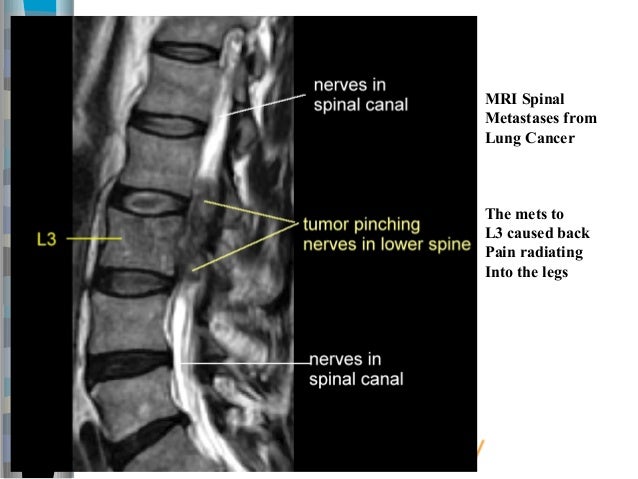 Hard spots on prostate Hard spots on prostate