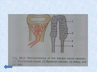 osteomyelitis & prosthetic joint infection 