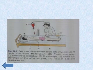 osteomyelitis & prosthetic joint infection 