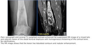 Comprehensive Overview of Bone and Soft Tissue Tumours: Diagnosis and ...