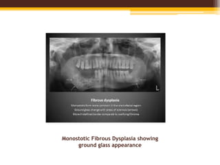 Monostotic Fibrous Dysplasia showing
ground glass appearance
 