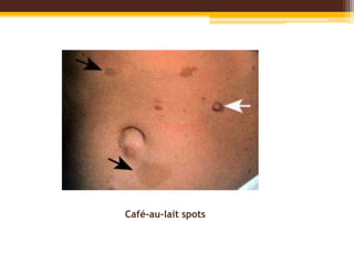 Café-au-lait spots
 