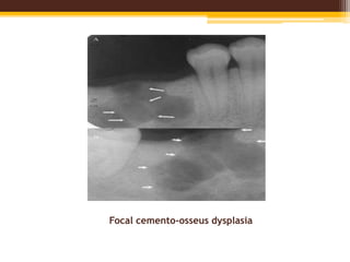 Focal cemento-osseus dysplasia
 