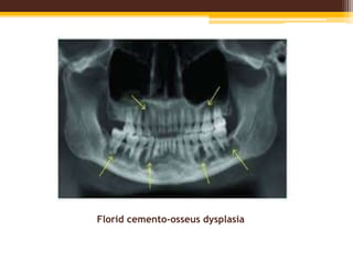 Florid cemento-osseus dysplasia
 