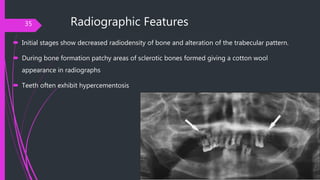 Radiographic Features
 Initial stages show decreased radiodensity of bone and alteration of the trabecular pattern.
 Dur...