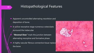 Histopathological Features
 Apparent uncontrolled alternating resorbtion and
deposition of bone.
 In active resorptive s...