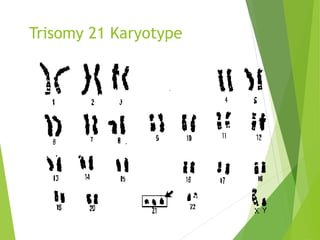 Trisomy 21 Karyotype
 