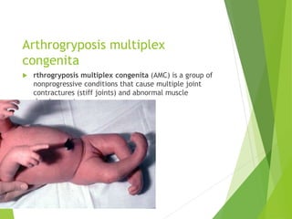 Arthrogryposis multiplex
congenita
 rthrogryposis multiplex congenita (AMC) is a group of
nonprogressive conditions that cause multiple joint
contractures (stiff joints) and abnormal muscle
development.
 