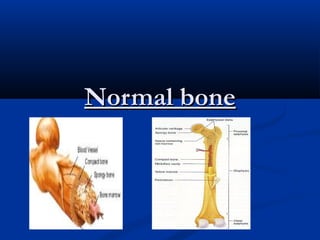 Normal boneNormal bone
 