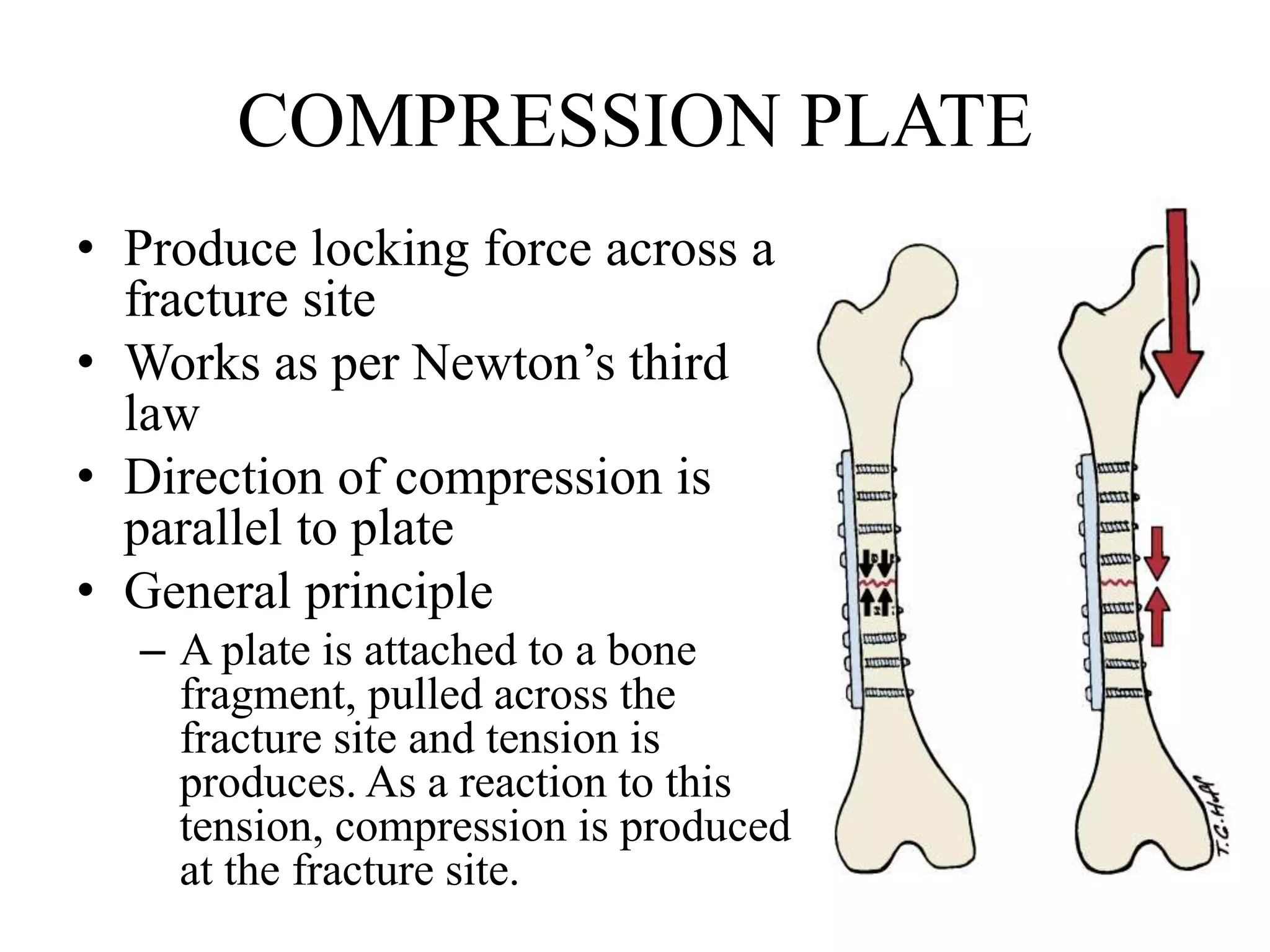 COMPRESSION PLATE
• Produce locking force across a
fracture site
• Works as per Newton’s third
law
• Direction of compression is
parallel to plate
• General principle
– A plate is attached to a bone
fragment, pulled across the
fracture site and tension is
produces. As a reaction to this
tension, compression is produced
at the fracture site.
 
