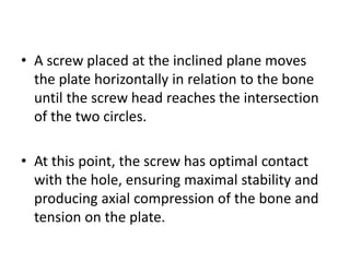 • A screw placed at the inclined plane moves
the plate horizontally in relation to the bone
until the screw head reaches the intersection
of the two circles.
• At this point, the screw has optimal contact
with the hole, ensuring maximal stability and
producing axial compression of the bone and
tension on the plate.
 
