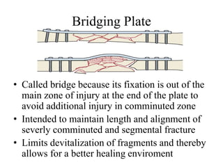 Bridging Plate
• Called bridge because its fixation is out of the
main zone of injury at the end of the plate to
avoid additional injury in comminuted zone
• Intended to maintain length and alignment of
severly comminuted and segmental fracture
• Limits devitalization of fragments and thereby
allows for a better healing enviroment
 