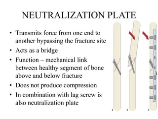 NEUTRALIZATION PLATE
• Transmits force from one end to
another bypassing the fracture site
• Acts as a bridge
• Function – mechanical link
between healthy segment of bone
above and below fracture
• Does not produce compression
• In combination with lag screw is
also neutralization plate
 