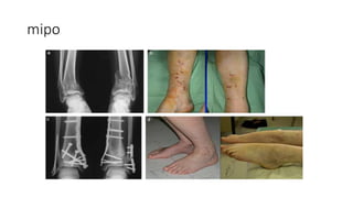 mipo
 
