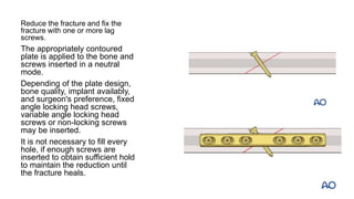 Reduce the fracture and fix the
fracture with one or more lag
screws.
The appropriately contoured
plate is applied to the bone and
screws inserted in a neutral
mode.
Depending of the plate design,
bone quality, implant availably,
and surgeon's preference, fixed
angle locking head screws,
variable angle locking head
screws or non-locking screws
may be inserted.
It is not necessary to fill every
hole, if enough screws are
inserted to obtain sufficient hold
to maintain the reduction until
the fracture heals.
 