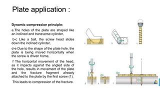 BONE PLATES ORTHOPEDIC SEMINAR AIIMS JODHPUR | PPTX