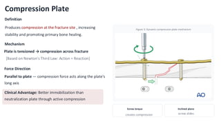 Comprehensive Overview of Bone Plates in Fracture Fixation and Surgical ...