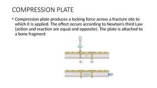Bone Plates modalities (1).pptx for residents | PPTX