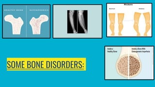 SOME BONE DISORDERS:
 