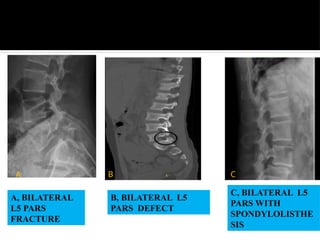 Radiological Interpretation of common bone Diseases | PPTX