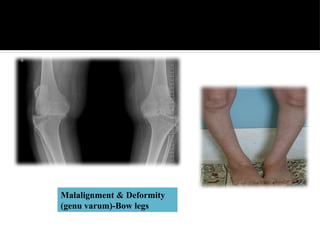 Radiological Interpretation of common bone Diseases | PPTX