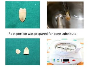 Bone regeneration and substitutes | PPT