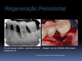 Regeneração Periodontal Rx peri-apical: defeitoprofundonaraizmesial do 3.6 Imagem  per op: Defeito infra ósseoCortesia Drs. Giuseppe Corrente e Roberto Abundo